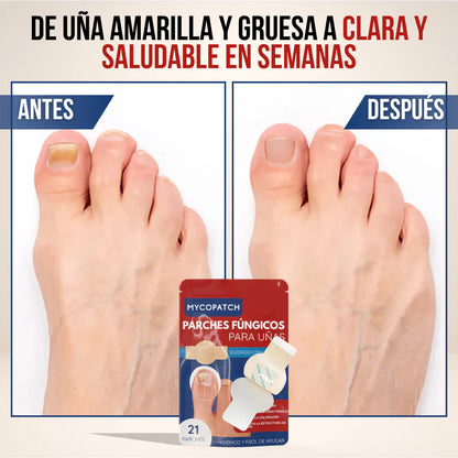 MycoPatch™ - Recupera tus uñas con la fuerza de la ciencia y la naturaleza