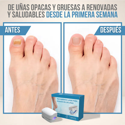 ClearNail Laser™ - Uñas sanas y fuertes desde la primera semana